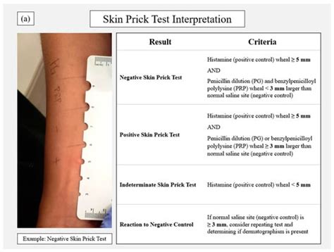 scratch test explanation|positive scratch test.